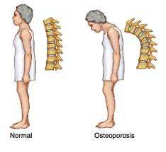 osteoporosis2